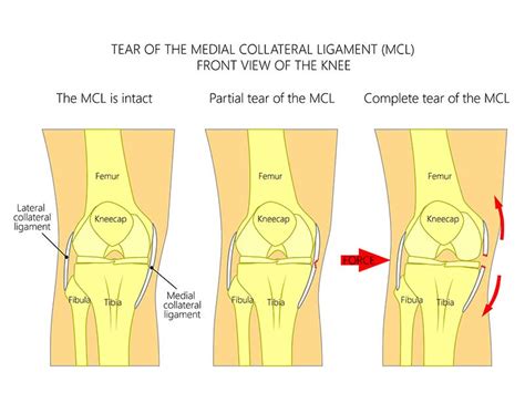 best test for ligament tear|grade 2 torn ligament treatment.